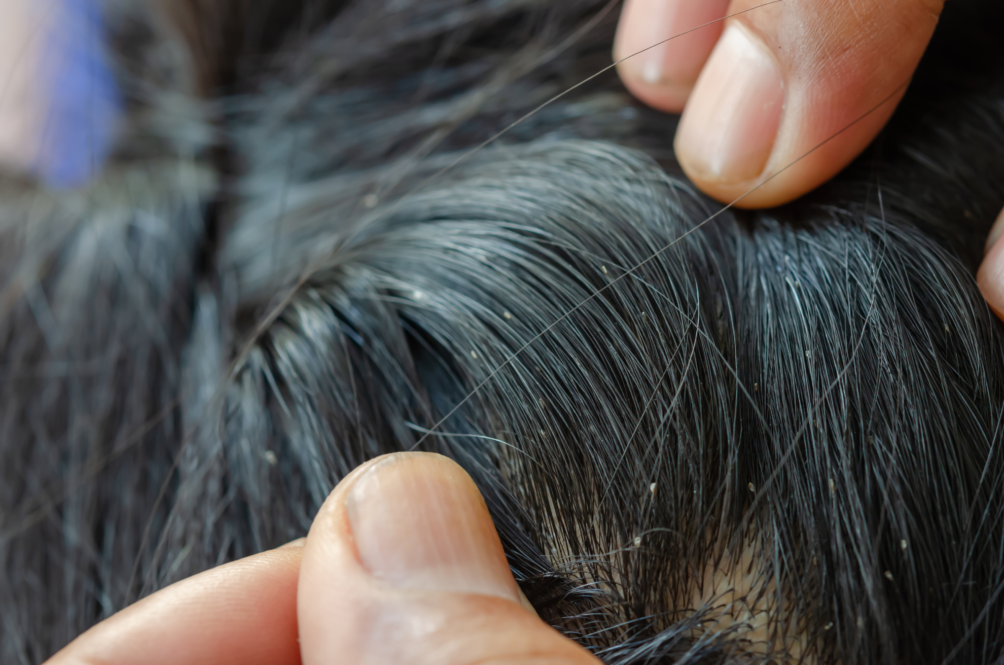 head lice